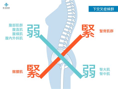 婕解釋|翹臀竟是「下交叉症候群」病徵！腰痛、肩頸、膝蓋痛也跟它有關…